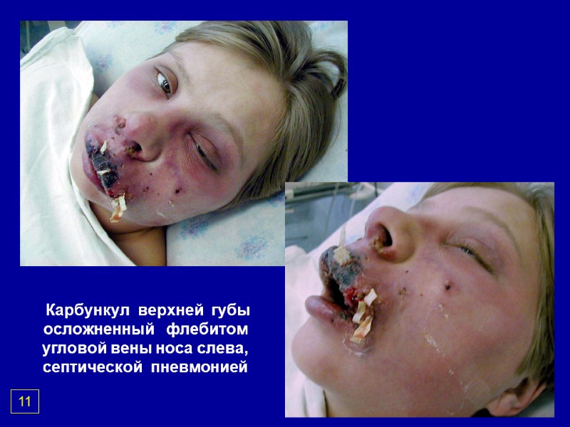 Карбункул  верхней  губы осложненный   флебитом угловой вены носа слева, септической